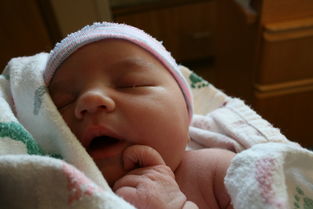【怀孕妊娠合并新生儿尿道下裂怎么尿道成形】